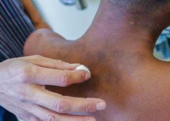 Durante o “Janeiro Roxo”, Saúde de Cotia reforça conscientização sobre a hanseníase